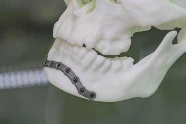 Beyaz bir kafatası modeline eklenmiş minyatür titanyum 3D protezin yakın çekimi, metal vidalarla detaylı yüz özellikleri, muhtemelen gösteri ya da gösterim için.
