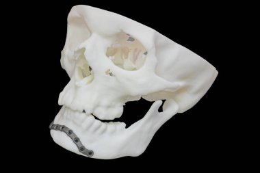 Yüzen bir insan kafatasına, detaylı anatomik özelliklere ve gerçekçi gölgelere sahip 3D baskılı titanyum protez modelinin yakın plan görüntüsü.