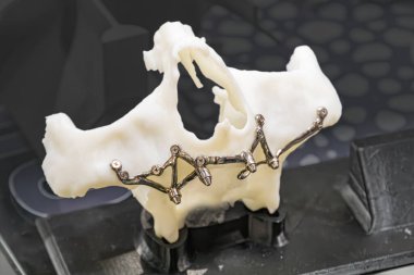 3D baskılı titanyum protezlere yakın plan, kemik benzeri yapısı ve çok sayıda küçük vida veya iğneleri olan karmaşık bir implantasyon cihazına benziyor. Yüksek çözünürlüklü deta