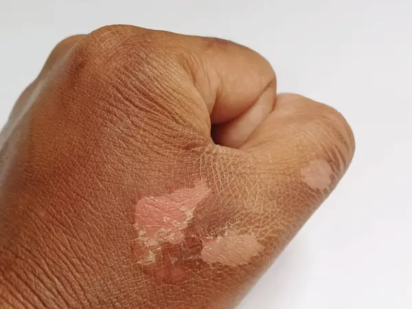 Male hand with scald scars, burn scars on the back of the hand