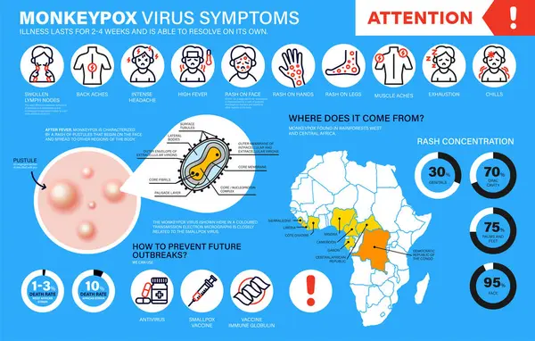 stock vector Monkeypox virus Symptoms. New cases of Monkeypox virus are reported in Europe and USA. Monkeypox is spreading in the Europe. It cause skin infections. Monkeypox virus detailed infographics