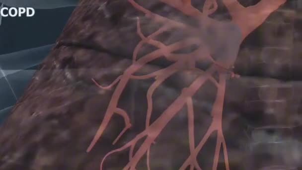 慢性阻塞性肺疾病 Copd 是一种慢性炎症性肺疾病 可导致肺部气流阻塞 — 图库视频影像