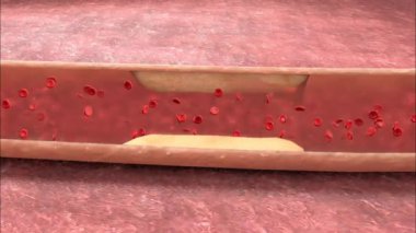 Anjiyoplasti, tıkanmış veya daralmış kan damarlarını açmak ve kan akışını iyileştirmek için yapılan bir prosedürdür..