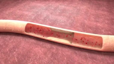 Kalp krizinin göstergesi, tıkanmış arterler ve kalbe giden kan akışı azalmış.