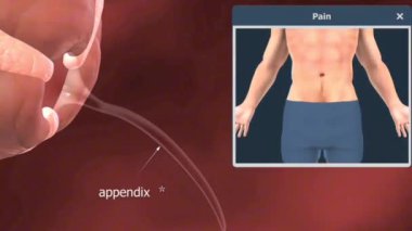 Apandisit nedenleri arasında abdominal ağrı, mide bulantısı ve ateş gibi semptomlara sahip tıkanıklık, enfeksiyon veya yabancı cisimler yer alıyor..
