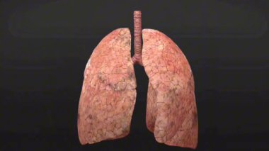  Hafif COPD ile akciğerlerin 3 boyutlu çizimi, solunum yolunun daraldığını ve hafif hasar gördüğünü gösteriyor..