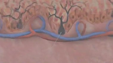 3D animation of human skin melanoma formation, illustrating abnormal growth of melanocytes.