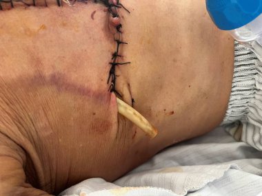 Intraperitoneal drain commonly is commonly used to remove fluid, pus or blood from peritoneum. Surgical drain and suture on woman after breast cancer surgery