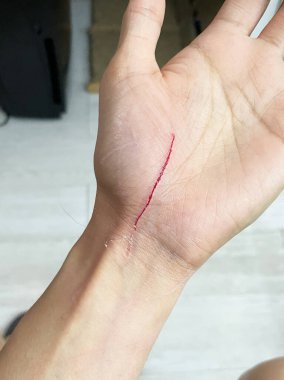 İnsan elinde kedi tırmalama yaraları var. Kedi tırmalaması göğüs yaralarına neden olur. 
