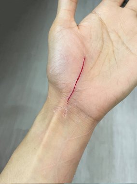 İnsan elinde kedi tırmalama yaraları var. Kedi tırmalaması göğüs yaralarına neden olur. 