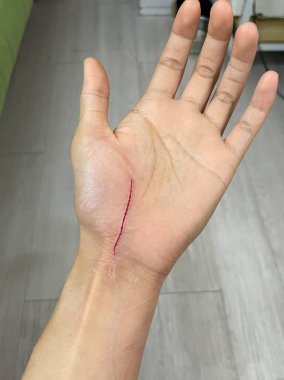 İnsan elinde kedi tırmalama yaraları var. Kedi tırmalaması göğüs yaralarına neden olur. 