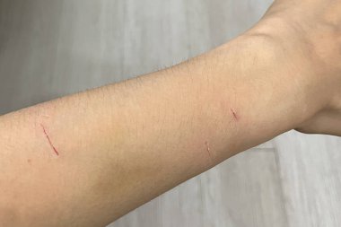 İnsan elinde kedi tırmalama yaraları var. Kedi tırmalaması göğüs yaralarına neden olur. 