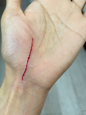 İnsan elinde kedi tırmalama yaraları var. Kedi tırmalaması göğüs yaralarına neden olur. 