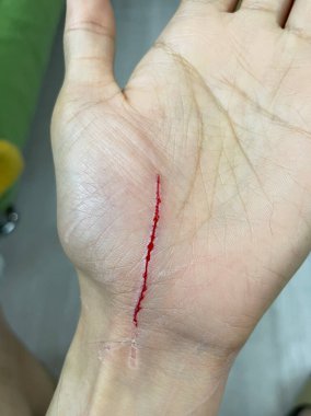 İnsan elinde kedi tırmalama yaraları var. Kedi tırmalaması göğüs yaralarına neden olur. 