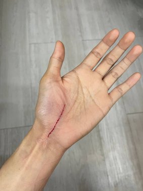 İnsan elinde kedi tırmalama yaraları var. Kedi tırmalaması göğüs yaralarına neden olur. 