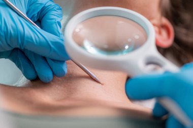 Siğillerin dermatoloji tedavisi, radyo dalgalarının gücünü kullanmak. Siğilleri tedavi eder ve pürüzsüz ve lekesiz bir cilt sağlar..  