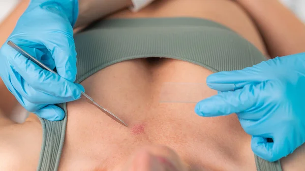 Dermatolog Starannie Pobiera Próbkę Skóry Podczas Zabiegu Mającego Celu Zdiagnozowanie — Zdjęcie stockowe