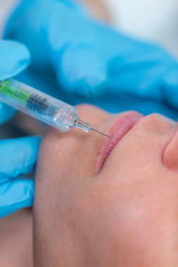 Dudakları hyaluronik asit dolgusu ile tedavi etmek. Dudakları hyaluronik asit kullanarak şişiren bir dermatoloji tedavisi..