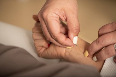 Sigara İçmeyi Durdurma İçin Akupunktur Tedavisi