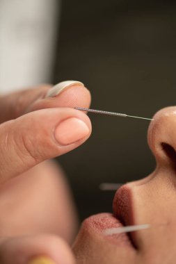 Sigarayı bırakmak için akupunktur terapisi.