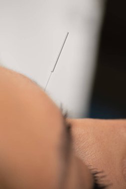 Sigarayı bırak akupunktur tedavisi