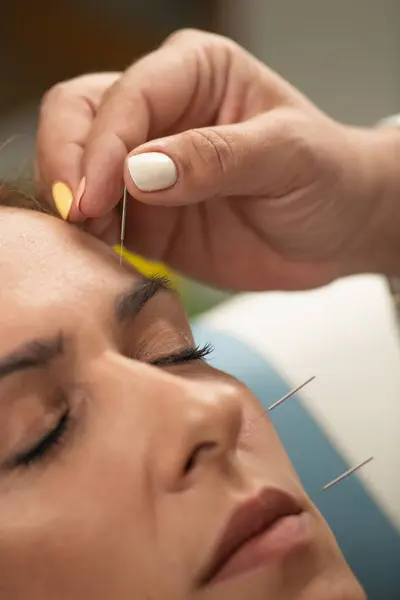 stock image Acupuncture Treatment for Nervus Facialis