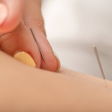 Akapunkturcu mide akupunktur noktalarını uyararak ödemi tedavi eder.