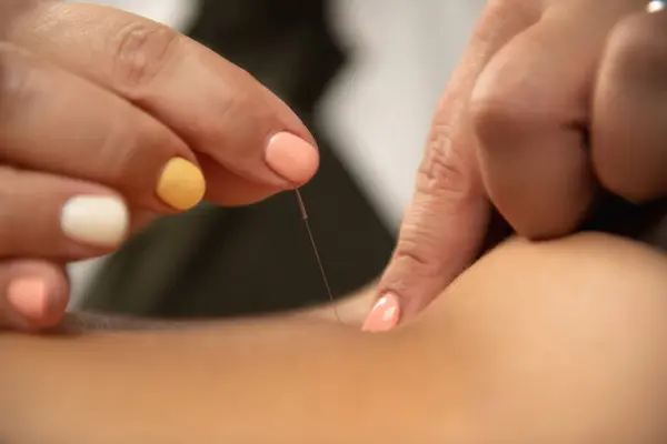 stock image Acupuncture for Ischialgia Back Pain, close up view