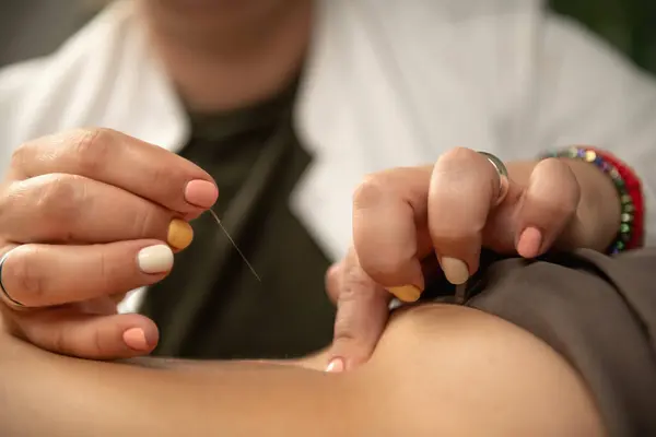 stock image Acupuncture for Ischialgia Back Pain, close up view