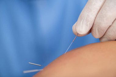 Fizyoterapist hastanın omzuna iğne yaparak kas düğümlerini hedef alıyor, acıyı azaltıyor ve hassas tetik noktası uyarımıyla hareket kabiliyetini arttırıyor.