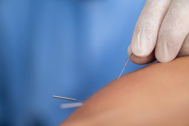 Fizyoterapist hastanın omzuna iğne yaparak kas düğümlerini hedef alıyor, acıyı azaltıyor ve hassas tetik noktası uyarımıyla hareket kabiliyetini arttırıyor.