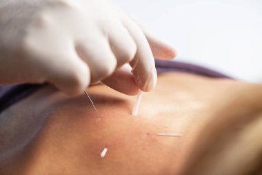 Fizyoterapist, kas ağrısını azaltmak, esnekliği arttırmak ve hedef nokta terapisi ile iyileşmeyi teşvik etmek için hastanın sırtına kuru iğne yapıyor.