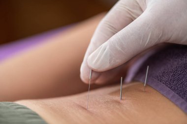 Kas ağrısını azaltmak için hastanın beline kuru iğne yapan fizyoterapist hedef alınarak iyileşme sürecini hızlandırıyor.