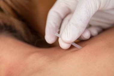 Fizyoterapist, kas gerilimini azaltmak için hastanın boynuna kuru iğne yapar. Hasta yüz üstü bir terapi masasında yatıyor. Hedeflenen rahatlama için iğne alıyor.