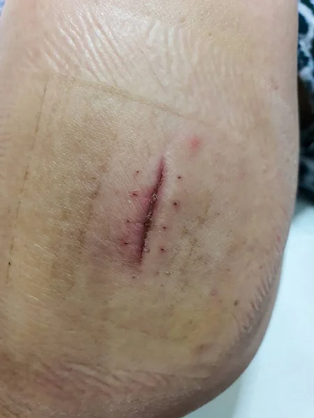 İnsan kolunda yara izi