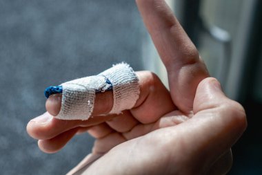 Eklem travmasının ardından son falanksı hareketsiz kılmak için orta parmağında özel ortozu olan çekiç parmağı.