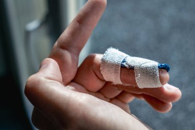 Eklem travmasının ardından son falanksı hareketsiz kılmak için orta parmağında özel ortozu olan çekiç parmağı.