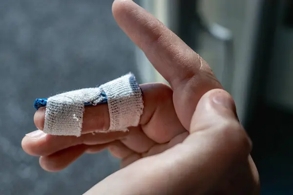 stock image Mallet finger with custom orthosis on the middle finger to immobilize the last phalanx following joint trauma