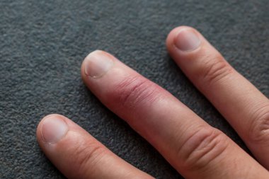 Eklem travmasını takiben orta parmaktan alınan alçı parmak iyileşmesi.