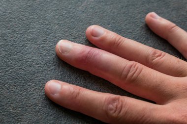 Eklem travmasını takiben orta parmaktan alınan alçı parmak iyileşmesi.