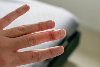 Eklem travmasını takiben orta parmaktan alınan alçı parmak iyileşmesi.