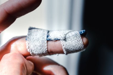 Eklem travmasının ardından son falanksı hareketsiz kılmak için orta parmağında özel ortozu olan çekiç parmağı.