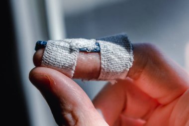 Eklem travmasının ardından son falanksı hareketsiz kılmak için orta parmağında özel ortozu olan çekiç parmağı.