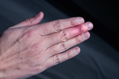 Eklem travmasını takiben orta parmaktan alınan alçı parmak iyileşmesi.