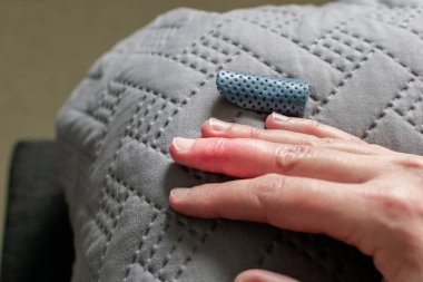 Eklem travmasını takiben orta parmaktan alınan alçı parmak iyileşmesi.
