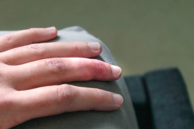 Eklem travmasını takiben orta parmaktan alınan alçı parmak iyileşmesi.