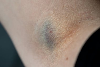 Kan testinden sonra kolunda çürük, hematom.