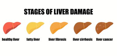 Alkolsüz karaciğer hasarı aşamaları. Karaciğer hastalığının tıbbi bilgisi. Beyaz arkaplanda düz çizgi film tarzında vektör pankartı