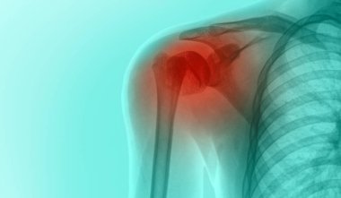 Eklem detaylı omuz röntgeni. 3d illüstrasyon.