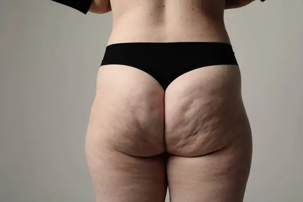 Obese female buttocks with cellulite and stretch marks. Horizontal mock-up. High quality photo.